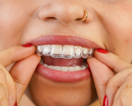 Invisalign Mysore